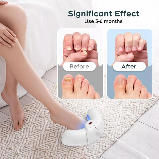 Nail Fungus Laser Treatment Device